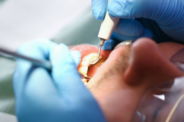 Best Emergency Dentist for Knocked-Out Tooth in Park City, TN